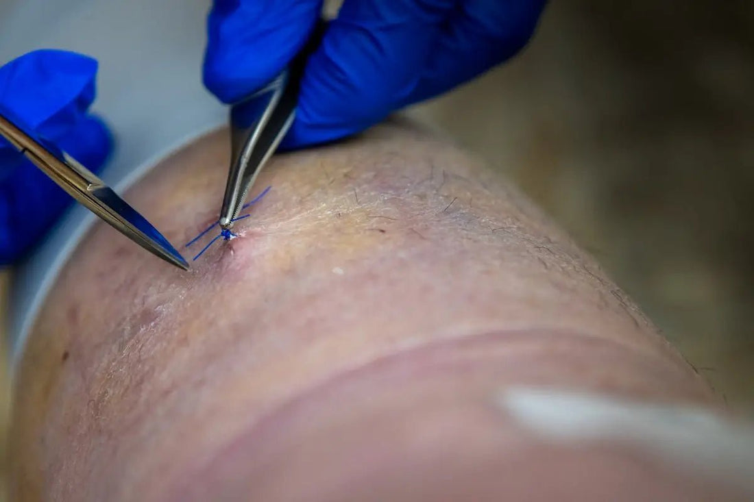 Surgical Sutures UK: Navigating the Top 10 for Aesthetic Clinics - Precision Dermal