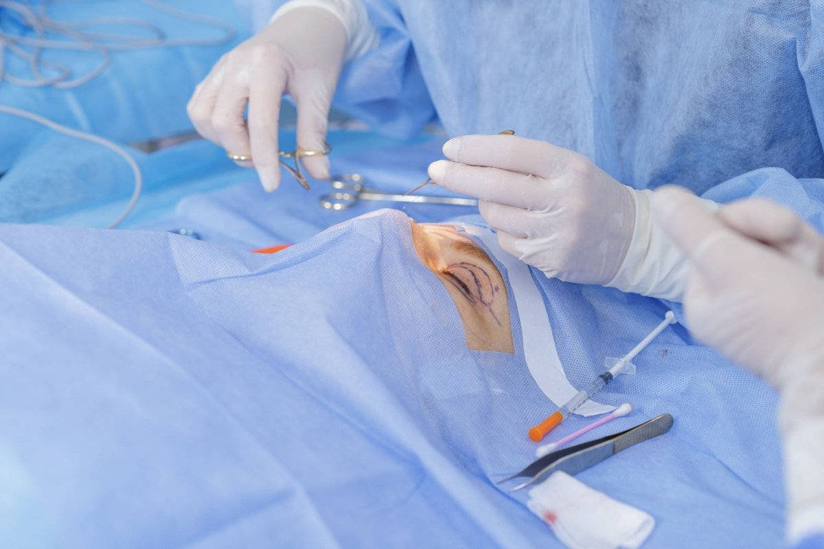 Discover the Preferred Sutures by UK Aesthetic Experts - Precision Dermal